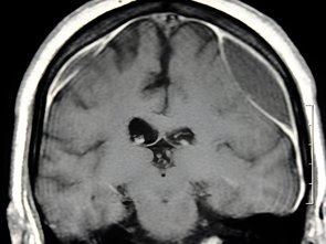 Chronic Subdural Hematoma
