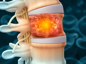 Spine Tumor