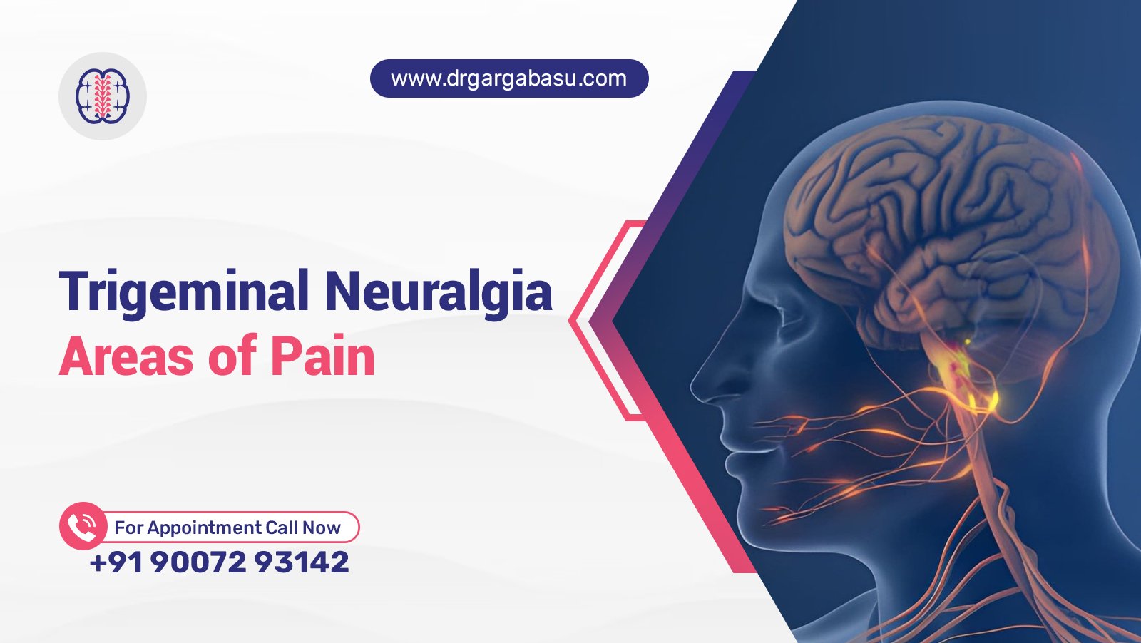 Trigeminal Neuralgia Areas of Pain