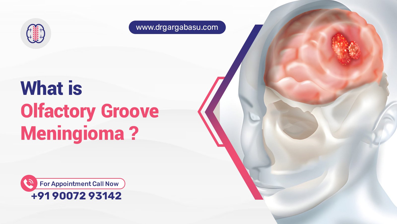 What Is Olfactory Groove Meningioma